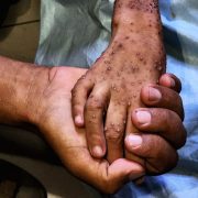 The Grave Long-Term Effects of the Gaza Malnutrition Crisis