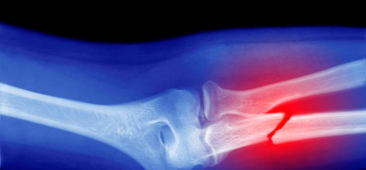 Microplastics Could Be Weakening Your Bones, Research Suggests