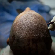 How Turkey Hacked the Hair Transplant Industry